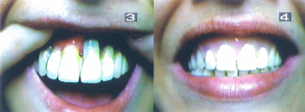 Before and after removable flexible cosmetic veneer Toronto