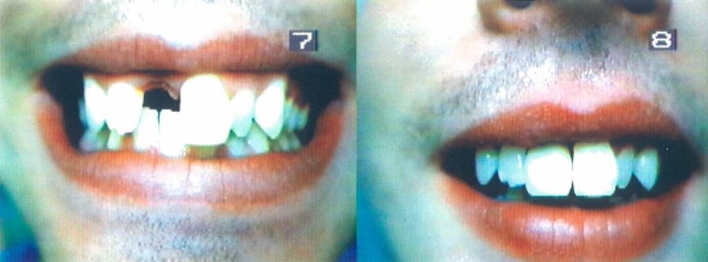 Implant Cosmetic Dentures