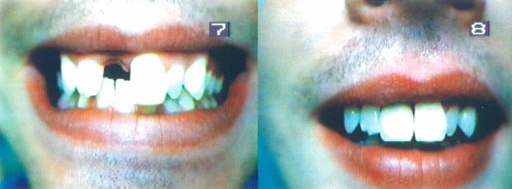 Immediate upper partial denture before and after Toronto