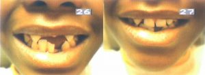 Cosmetic Pediatric Flexible Partial Dentures (CPFPD)