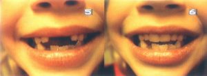 Cosmetic Pediatric Flexible Partial Dentures (CPFPD)